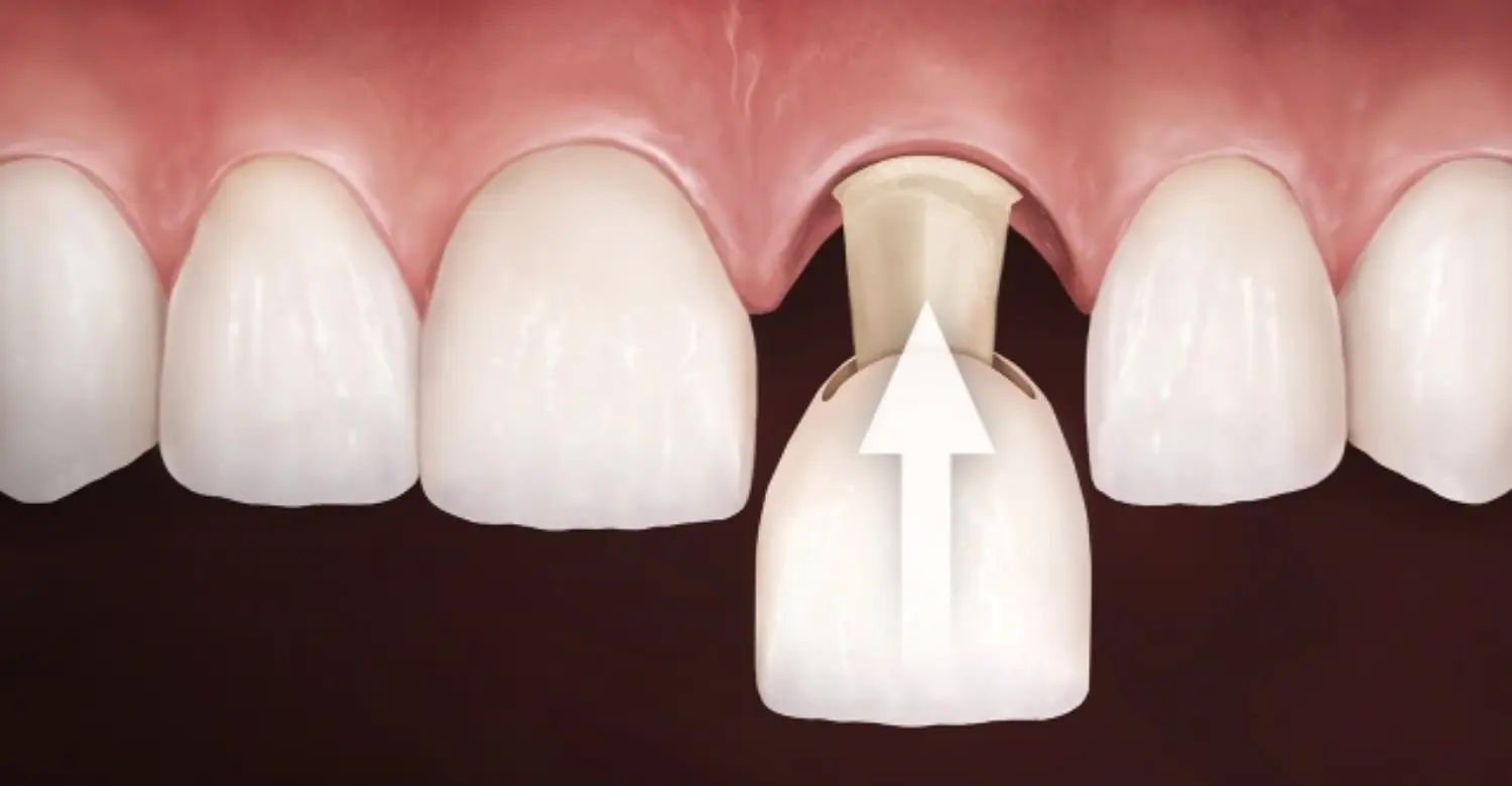 Dental Crown 2